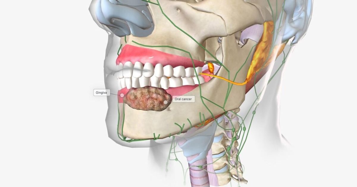 bone spicule