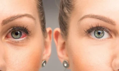 stye versus pink eye