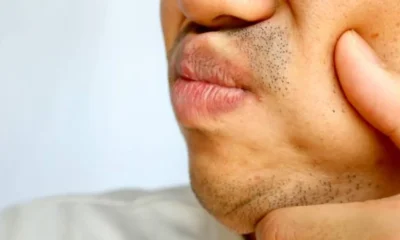 swelling of the roof of the mouth